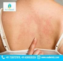 Hyderabad's Premier Service for Alleviating Hives: Expert Urticaria Treatment