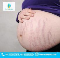 Stretch Marks Removal Treatment in Hyderabad