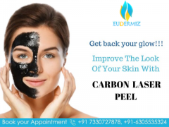 Carbon Laser Peel In Hyderabad At Eudermiz Clinic