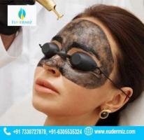 Carbon Peel Treatment Available in Hyderabad