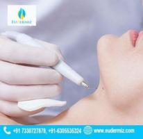 Discover Warts Removal Therapy Now Available in Hyderabad at Eudermi 