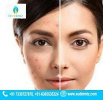 Acne and Acne Scars Treatment at Eudermiz clinic.