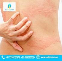 Allergies Treatment Services in Hyderabad at Eudermiz Clinic.