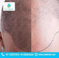 Hair Transplant Treatment in the Heart of Hyderabad