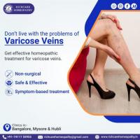 Varicose Veins Homeopathy Treatments in Bangalore -Rich Care 