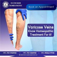 Varicose Veins Homeopathy Treatments in Bangalore -Rich Care 