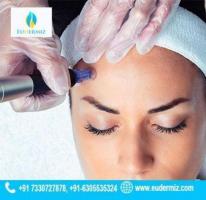 Microneedling RF Treatment in Hyderabad at Eudermiz Clinic