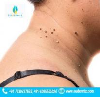 Moles Removal Services in Hyderabad for Clear, Beautiful Skin