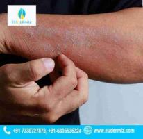 Psoriasis Treatment Services at Eudermiz Clinic, Hyderabad