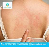 Urticaria Treatment at Eudermiz Clinic for Skin Wellness