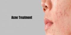 Acne Scar Reduction In Bangalore