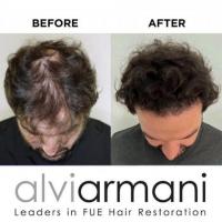Revolutionary Solutions Advanced Hair Loss Treatments 
