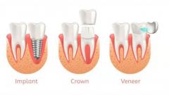 Same-Day Crowns  in Las Vegas at Functional Aesthetic Dentistry 