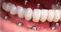 Same-Day Crowns  in Las Vegas at Functional Aesthetic Dentistry 