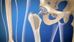 Consult the Best Hip Replacement Surgeon in Delhi NCR Today!
