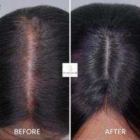 Hair Replacement System for Women