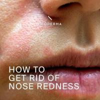 Redness Around Nose | NEODERMA 