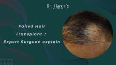 Failed Hair Transplant ? Expert Surgeon explain