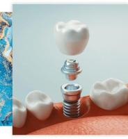 Discover Top Dental Implant Services in Columbia, SC, by Soda City Dentistry