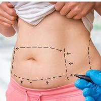 Tummy Tuck Procedure at Maryland Specialty Group: Achieve Your Dream Body