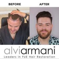 Premier Hair Transplant Solutions in Durban