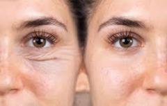 Blepharoplasty Helps Improve the Appearance of Your Eyelids