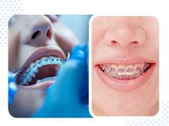 How Can Smile Dental Clinic in Jaipur Improve Your Smile?