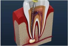 ROOT CANAL TREATMENT in Kolkata