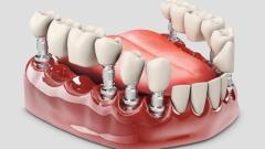 Best Tooth Implant Services in Chandigarh