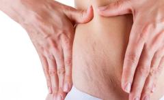 Stretch Marks Treatment in Delhi - Skinology Clinic