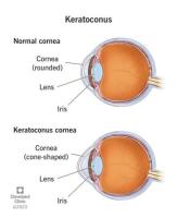 Keratoconus Treatment Specialist in Dubai – Dr. Rahul Raghav