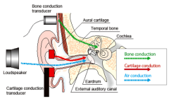 Restoring Hearing in Congenital Deafness: Dr. Meenesh Juvekar's Expertise in Cochlear Implants