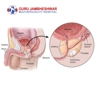 Advanced Prostate Cancer Treatment in Haryana – Expert Urologists & Oncologists