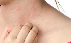 Get Best Urticaria Treatment in Delhi at Skinology Clinic 