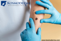 Kosmoderma: Expert Wart and Mole Removal Services in Bangalore