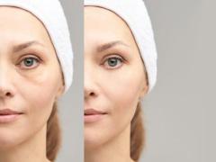 Ultherapy: Safe & Effective Skin Tightening Treatment