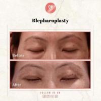 Blepharoplasty surgery in Delhi