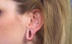 Get The Best Earlobe Repair Treatment In Delhi At Skinology Clinic