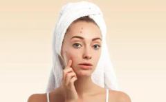 Acne scar treatment in Delhi