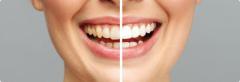 Discover the Best Deals on Teeth Whitening Cost