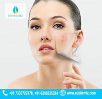 Say Goodbye to Acne: Discover Advanced Treatments at Eudermiz, Hyderabad