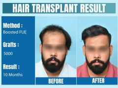 Hair Transplant in Delhi | Dr. Gaurav Garg - Top Hair Transplant Surgeon