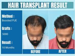 Hair Transplant in Delhi | Dr. Gaurav Garg - Top Hair Transplant Surgeon