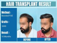 Hair Transplant in Delhi | Dr. Gaurav Garg - Top Hair Transplant Surgeon