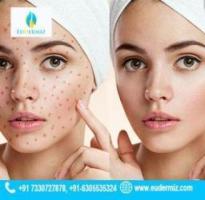 Advanced Pimple Removal at Eudermiz Hyderabad