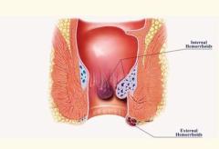 How The Piles Doctor Mumbai Are Revolutionizing Hemorrhoid Treatment