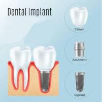 High-Quality Dental Implants in Casula - Restore Your Smile with Confidence