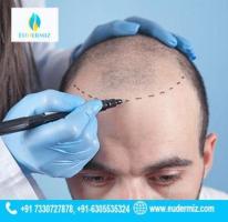 Why Choose Eudermiz for Your Hair Transplant Journey in Hyderabad