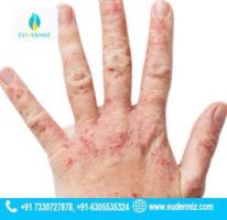 Effective Psoriasis Treatment Solutions in Hyderabad at Eudermiz Clinic