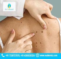 Safe and Effective Mole Removal Treatment at Eudermiz Clinic, Hyderabad